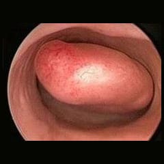 Pólipos endometriales